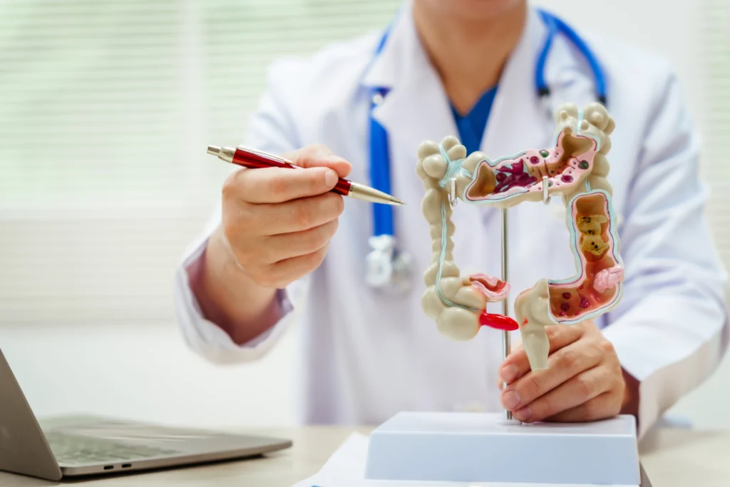 A doctor explaining colorectal cancer prevention using an anatomical model.